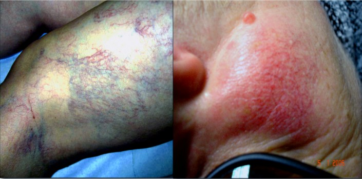 lasercutanée1