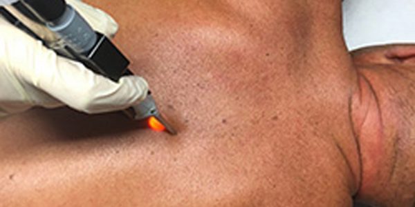 Epilation laser - formation lasers médicaux Epilation laser - formation lasers médicaux