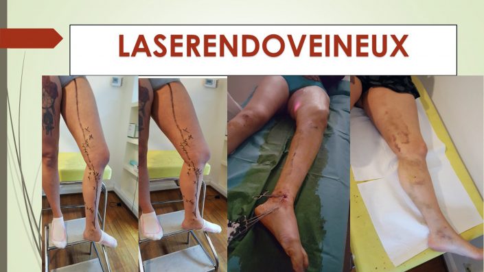 LAERENDOVEINEUX