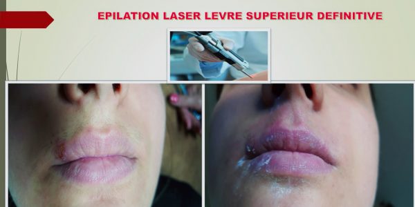 Epilation laser