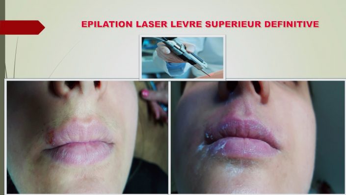 EPILATION LASER Laser intervient depuis plus de 30 ans sur de nombreux dispositifs d’accompagnement et de formation professionnelle. La confiance toujours renouvelée des institutions et des entreprises partenaires permet chaque année à prés de 1000 stagiaires d’effectuer un parcours de formation au sein de notre organisme.