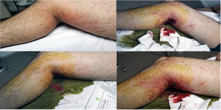 Thrombose veineuse superficielle