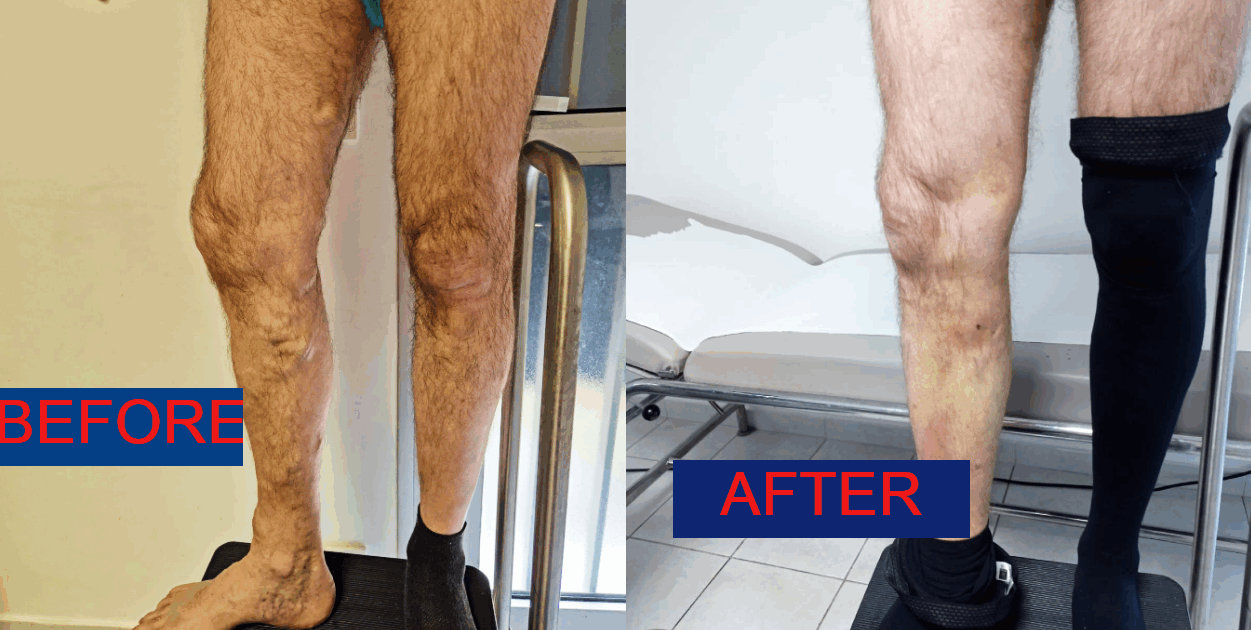 Le laser endoveineux est une technique de traitement des varices qui remplacel’ancienne méthode chirurgicale appelée « stripping ». Le laser endoveineux est une technique de traitement des varices qui remplacel’ancienne méthode chirurgicale appelée « stripping ».