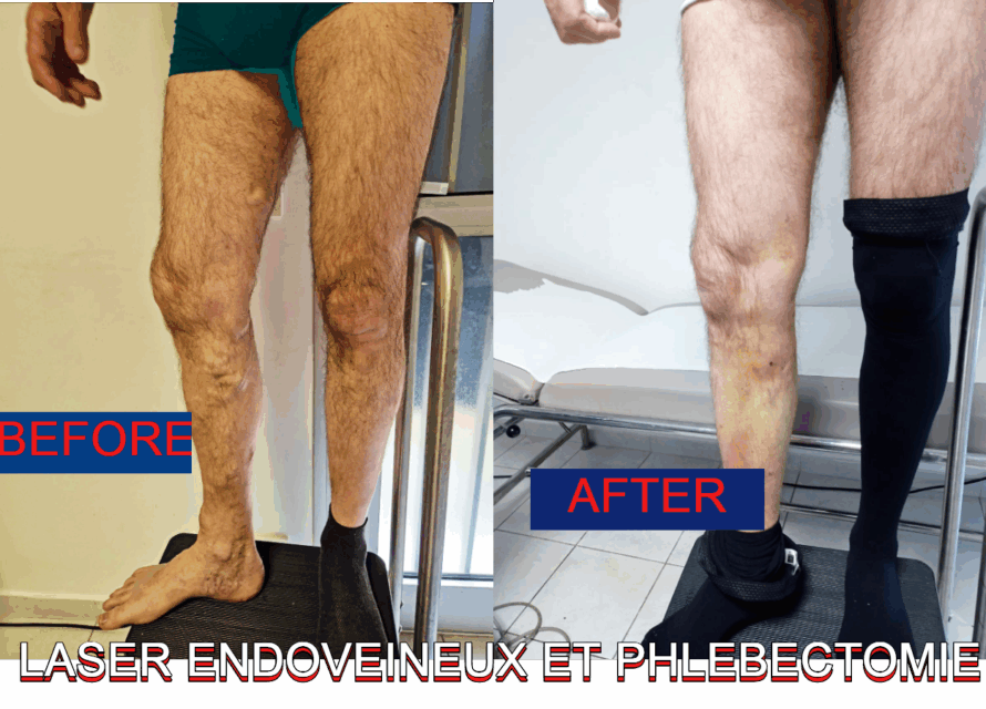 Le laser endoveineux est une technique de traitement des varices qui remplacel'ancienne méthode chirurgicale appelée « stripping ».