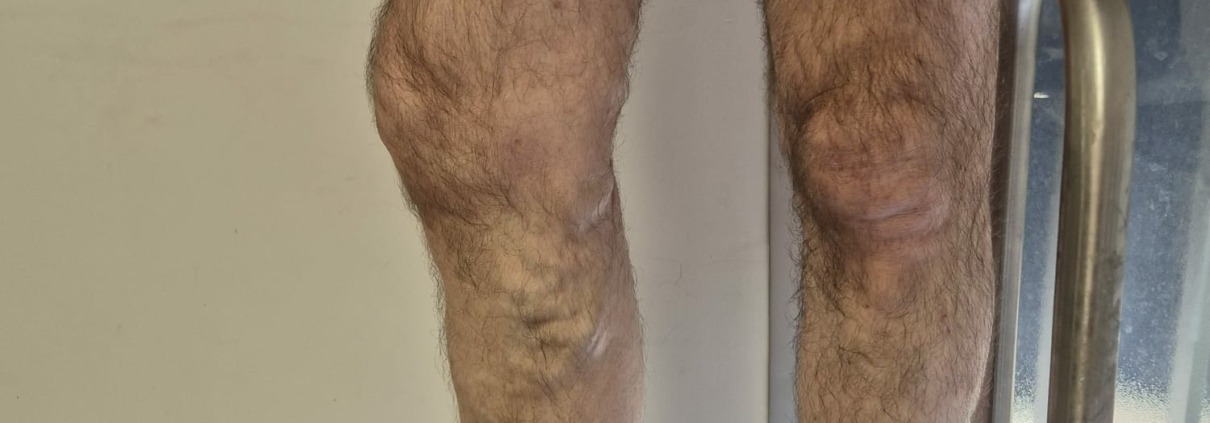 Le laser endoveineux est une technique de traitement des varices qui remplacel’ancienne méthode chirurgicale appelée « stripping ». Le laser endoveineux est une technique de traitement des varices qui remplacel’ancienne méthode chirurgicale appelée « stripping ».