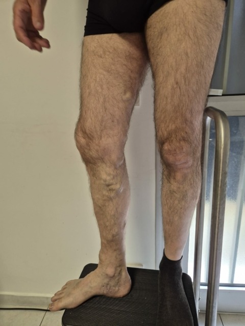 Le laser endoveineux est une technique de traitement des varices qui remplacel'ancienne méthode chirurgicale appelée « stripping ».