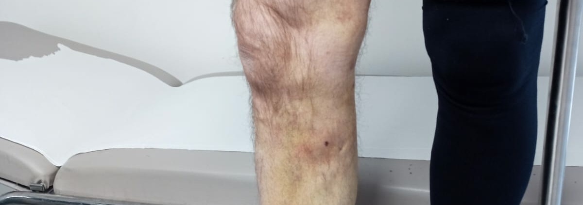 Le laser endoveineux est une technique de traitement des varices qui remplacel’ancienne méthode chirurgicale appelée « stripping ». Le laser endoveineux est une technique de traitement des varices qui remplacel’ancienne méthode chirurgicale appelée « stripping ».