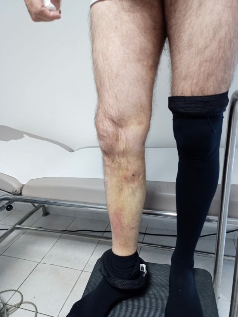 Le laser endoveineux est une technique de traitement des varices qui remplacel'ancienne méthode chirurgicale appelée « stripping ».